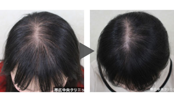 薄毛治療