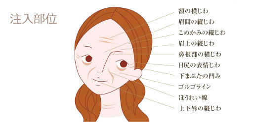 ヒアルロン酸注入部位