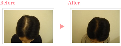 女性の薄毛治療の症例写真2