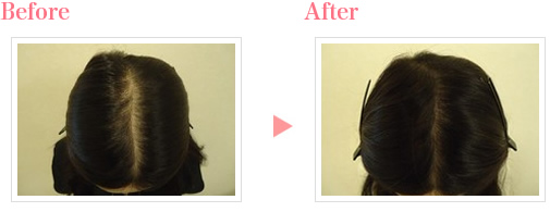 女性の薄毛治療の症例写真3