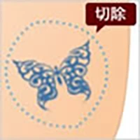 刺青の切除